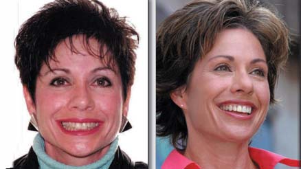 blog-bracelift_facelift