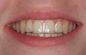 Clear retainer for adults