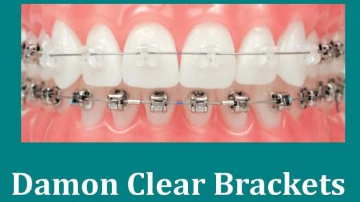 blog-orthodontic_tooth_movement