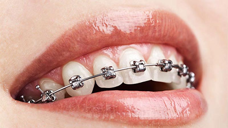 blog-full_face_orthodontics