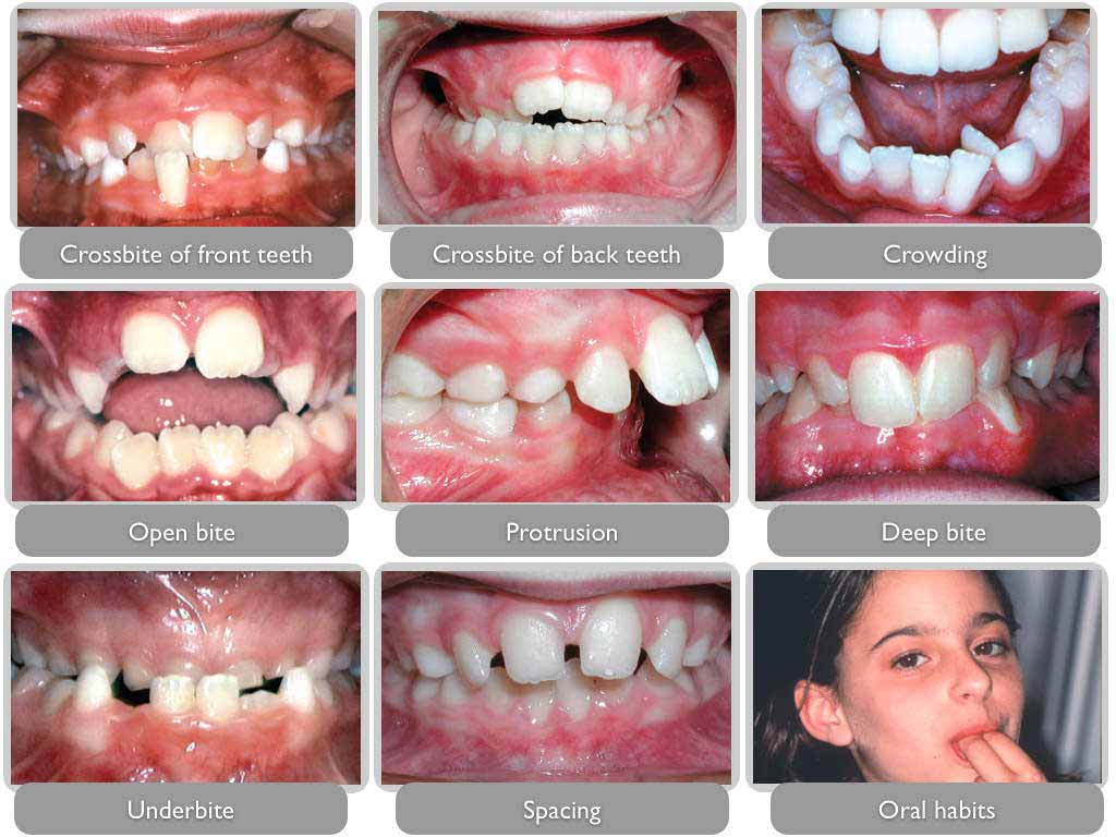 Screening for children