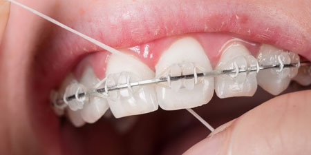Flossing with braces