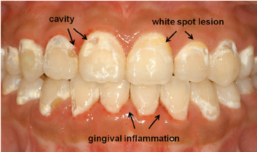 Dental problems from incorrect brushing